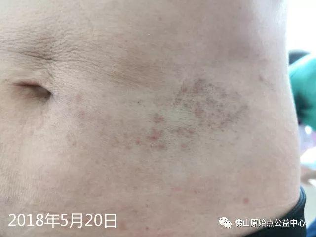 原始点调理带状疱疹：轻松快捷效果好