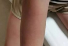 案例分享:突发性过敏全身痒调理案例-七不姜 生姜养生网-明德CSA生态姜园&明安农业